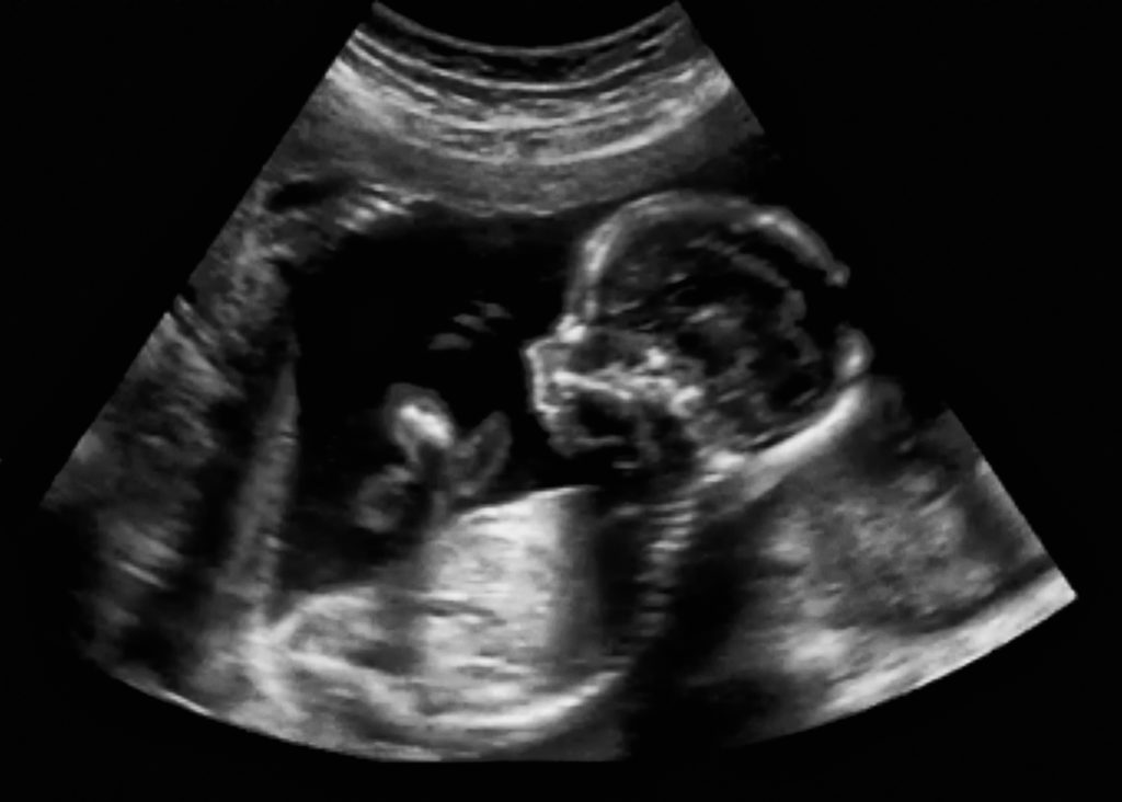 Ultrasound and Roe v. Wade