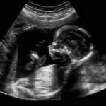 Ultrasound and Roe v. Wade